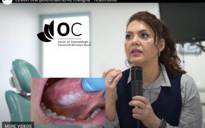 Lesión Oral Potencialmente Maligna: Testimonio de Paciente